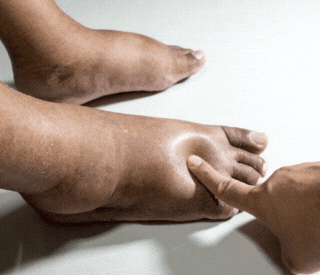 O que a ciência mais recente diz sobre os remédios do pós-infarto